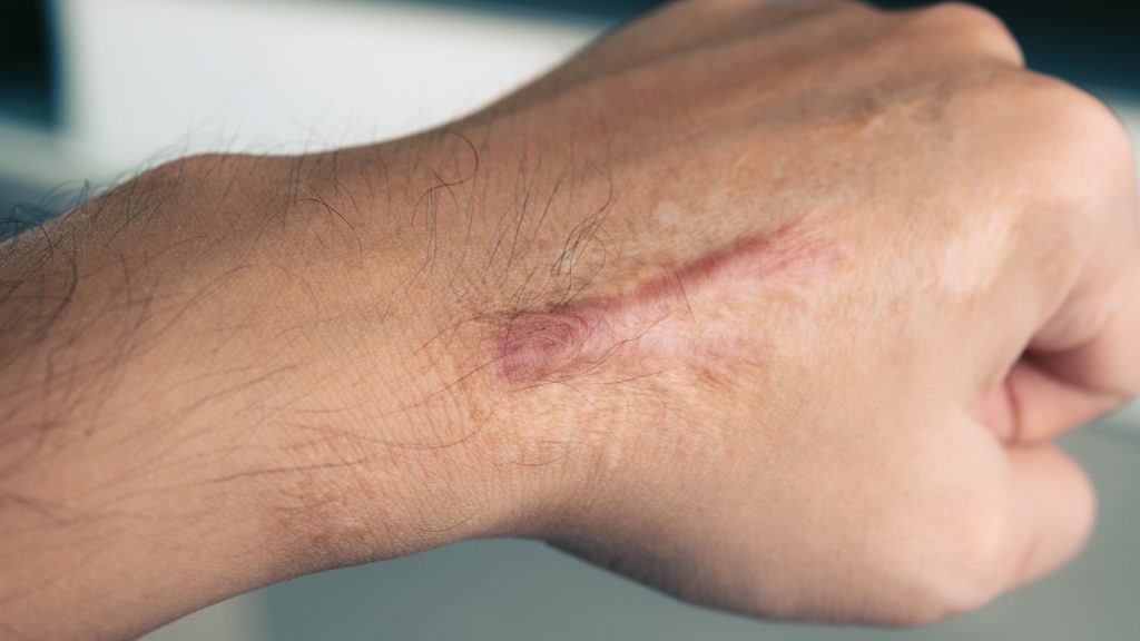 Terapia blizny 2 Terapia blizn Gdańsk