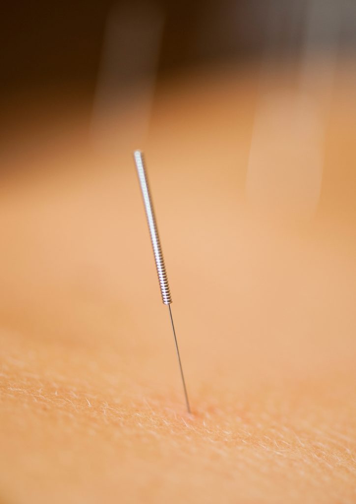Dry needling Suche igłowanie Gdańsk