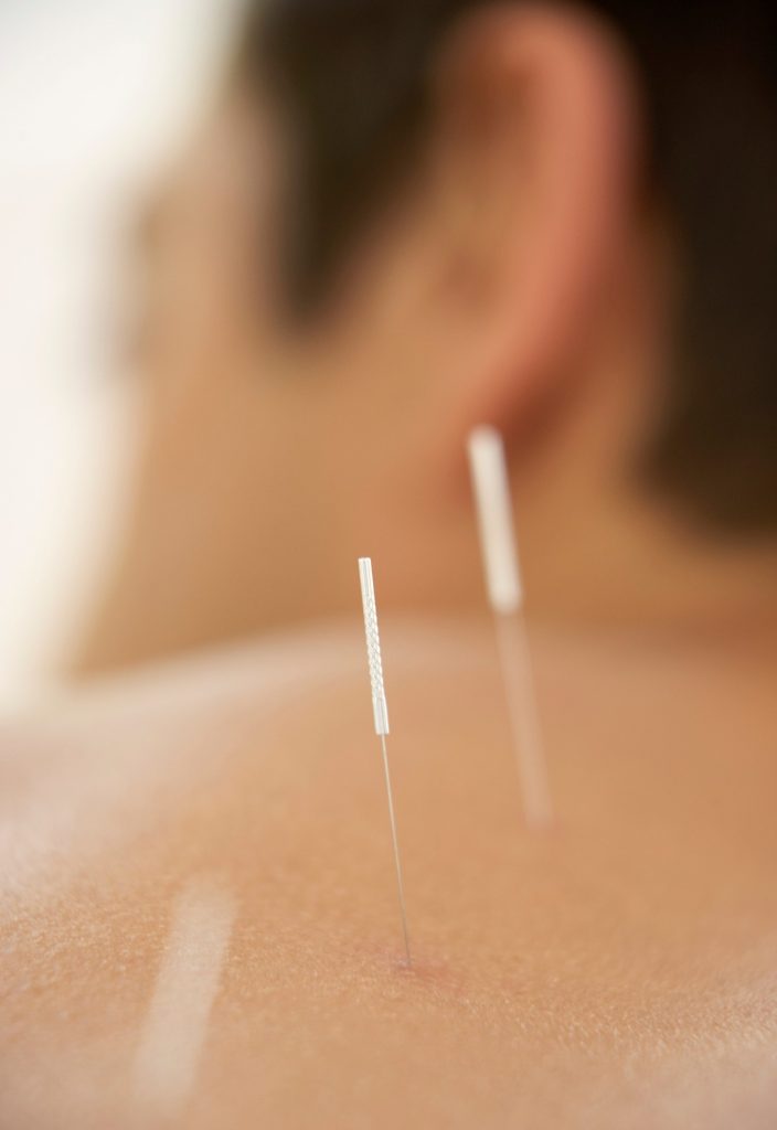 Suche iglowanie Gdansk Suche igłowanie Gdańsk